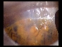 ADHESIONS BOWELS OMENTAL ADHESIONS BOWELS OMENTAL
